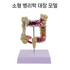 치질 결장 직장 모형 병리학 모델 위장 병변 해부학 항문외과, 소형 대장 병리학