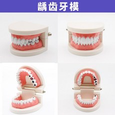 구강 치아 모형 치과 병원 시연 설명 교육용 모형 소품, 충치 모델