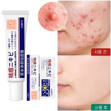 여드름 크림 여드름 자국 제거 여드름 성장 억제, 2개, 30g