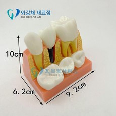 썩은이 분류 이 임플란트 구강 치아모형 교육용 이빨 실습 구조 교육 교구 모형, 4배 심기 해설 S2017
