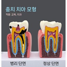 치과 구강 충치 모형 교육 교구 진료소 병리 치아 인체모형, A. 6x 충치 치아 해부 모델