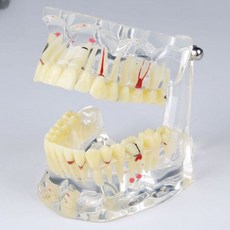 이빨모형 덴티폼 치과 구조 구강 재료 발치 틀니 수업모형 잇몸 수업 장식, B. 치아 결손 성인병리학