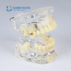 치아 충치 구강모형 우식 발달 교육 실습용 교구 이빨 잇몸 해부, 치아가 빠진 성인병리모델 4001-2