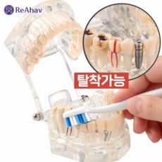 레아하브 클리어덴트 투명치아모형, 1세트