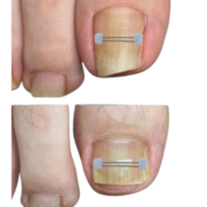 신짱 컴퍼니 파고드는 내성발톱 와이어 팁(10p), 10개