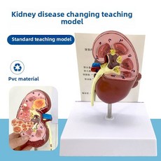 해부모형 인체 안면 뇌혈관 근육 모형, A. 신장 병변 모델 요신 모델 신장 공 신장