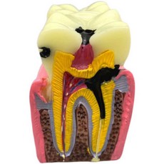 치아모형 이빨 실습 충치 스케일링 덴티폼 치과 교구, 1개, 병리학적 수리 모델 화이트 2001