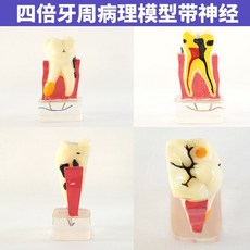 치열 교정 치아모형 치과 구강 모델 덴티폼 금속 교정기 구조, 사배치주모형 신경대, 신경 포함 4중 치주 모델