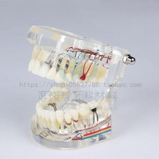 치과 치아모형 이빨 구강 진료실 충치 모형 교육용, 화이트, 1개