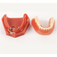 AM010 하악 임플란트 & 오버덴쳐/ 임플란트 치아 모형 하악 임플란트 틀니 환자 교육 설명 치과 병원 장식 장식품