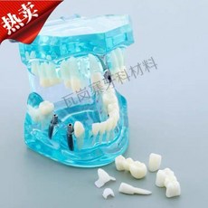 치아 충치 구강모형 우식 발달 교육 실습용 교구 이빨 잇몸 해부, 병리학적 수리 모델 블루 2001