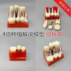 치아 충치 구강모형 우식 발달 교육 실습용 교구 이빨 잇몸 해부, 프로모션 모델 2017년 블루네일 B모델