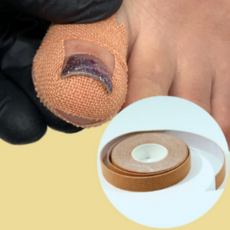 드메이 내성발톱 문제성네일 내향성 파고드는 발톱 테이프 내성발톱케어 셀프치료, 1개