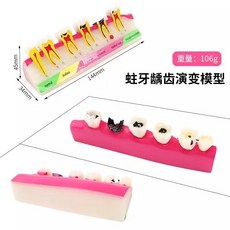 치열 교정 치아모형 치과 구강 모델 덴티폼 금속 교정기 구조, 치아 우식 모델