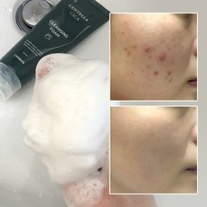 여드름 기능성 클렌징폼 좁쌀 아크네 사춘기 청소년 화장품 수부지 센텔라 시카 클렌저, 1개여드름모공피지각질제거센텔라시카폼클렌징, 120ml, 1개