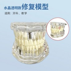 치아모형 치과 탈착식 임플란트 투명 개폐형 교육용 전시, 클리어 크리스탈