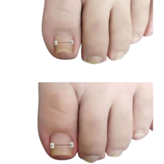 신짱컴퍼니 내맘대로길이 조절 내성발톱 셀프 교정기, 1세트