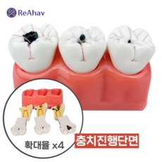 레아하브 충치가이드 4배 치아 충치 진행 모델 단계별 설명 모형 치과 신경치료 실습 교구 병원 장식 환자, 1세트