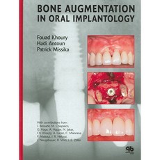 Bone Augmentation in Oral Implantology, Quintessence Pub Co