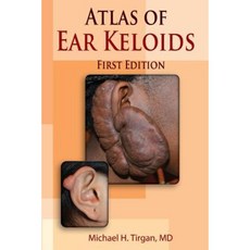 Atlas of Ear Keloids Paperback, Michael H. Tirgan