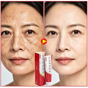 멜라논크림 기미크림 기미잡티 제거 색소침착 미백크림 스팟아토닝 기미 주근깨 검버섯 크림 YONICE 포장
