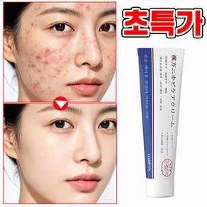 [본토출하] 여드름 흉터 개선 크림 피부재생 크림 청소년 사춘기 피부청결 YONICE 흔적지우개