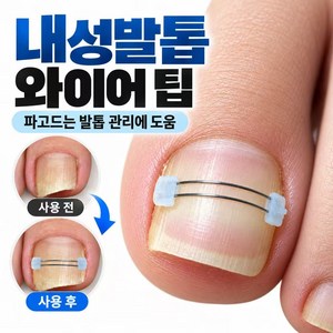 신짱 컴퍼니 파고드는 내성발톱 와이어 팁(10p), 1, 1세트