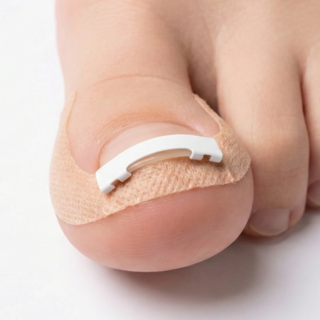 라이언문 니티놀 내성발톱 교정기, 1세트