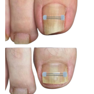 신짱 컴퍼니 파고드는 내성발톱 와이어 팁(10p), 10개