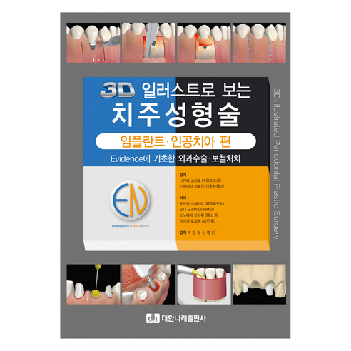 3D 일러스트로 보는 치주성형술:임플란트 인공치아 편, 대한나래출판사, 오카다 소헤이타 , 오다 노리미 , 소노야마 와타루 , 야마바 토오루