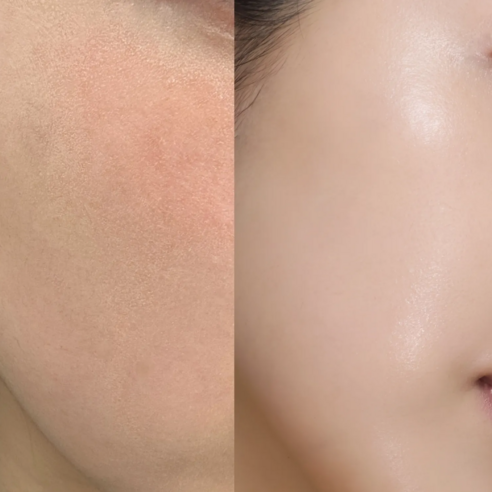 점뺀후 관리크림 시카 멜라 리페어 크림 약국입점 초고함량 리페어 성분 시카 판테놀 알란토인 EGF 식약처인증 미백기능 피부과 레이저후 바로 사용 가능 피부저자극 테스트 완료 이미지 2