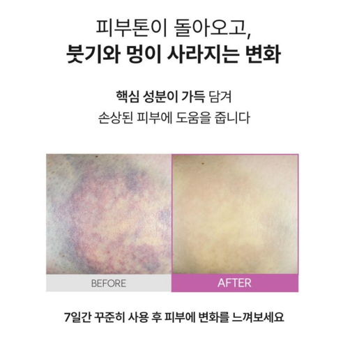 병원 약국 | 리누젠 아르니카 패스트 크림 | 쌍수 눈가 멍 지방흡입 붓기 | 유아 멍연고 | 멍 크림 | Bruise Cream | 말밤 마녀헤이즐 호박 추출물 이미지 2