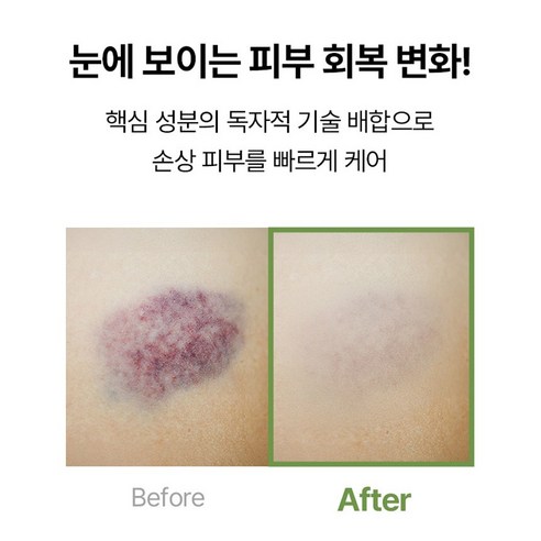 약국입점 메디케이 카밍덤 크림 대용량 50ml 멍크림 시술후 멍붓기완화 점뺀후관리 멍제거 흔적 재생크림 이미지 2