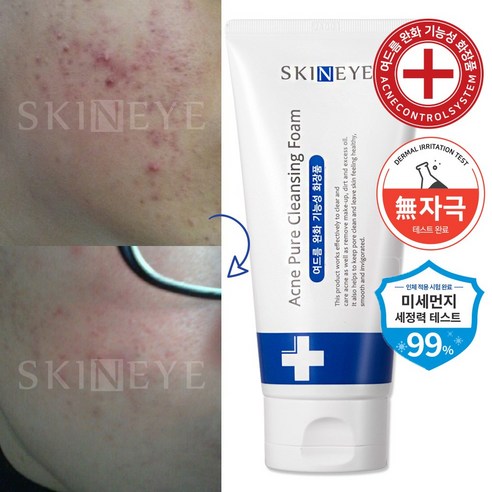 스킨아이 AC 퓨어 워터리 토너 + 에센셜 로션 아크네 청소년 여드름 클... 솔직 후기 | 피부 타입별 분석 - 상품 이미지 4