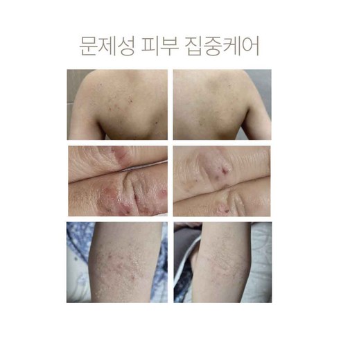 [정품] 가려움 아토 피부 등드름 3일 진정 미스트 PDRN 아토샷 솔직 후기 | 실사용자 리뷰 분석 - 상품 이미지 3
