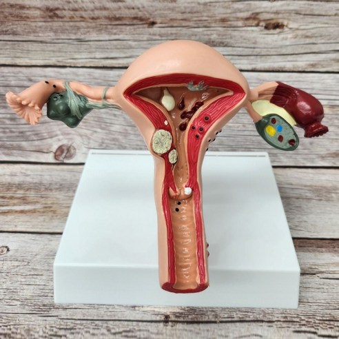 여성 자궁 병변 해부학 인체 모형 스탠드 안내서, 1세트
