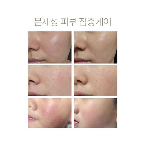[정품] 가려움 아토 피부 등드름 3일 진정 미스트 PDRN 아토샷 솔직 후기 | 실사용자 리뷰 분석 - 상품 이미지 4