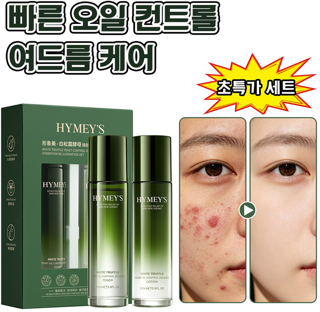 워터밸런스 스킨 로션 세트 여드름화장품 지성 피부 트러블 진정 스킨 화장품 여드름 진정 케어 토너100ml+ 로션 100ml 세트, 1세트