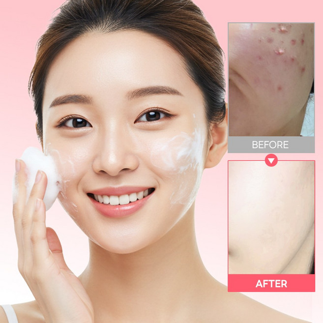 [당김제로] 베라모어 약산성 로즈앤티트리 버블 딥 클렌징폼 여드름 저자극 폼클렌징 세안제 트러블 피지 모공 블랙헤드 순한 클렌징폼 노워시 딥클렌징 티트리 진정 세안, 1개, 150ml