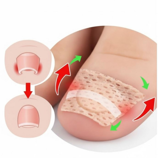 ez패치 내성발톱 교정기 내향성 발톱 교정 테이프, 50개