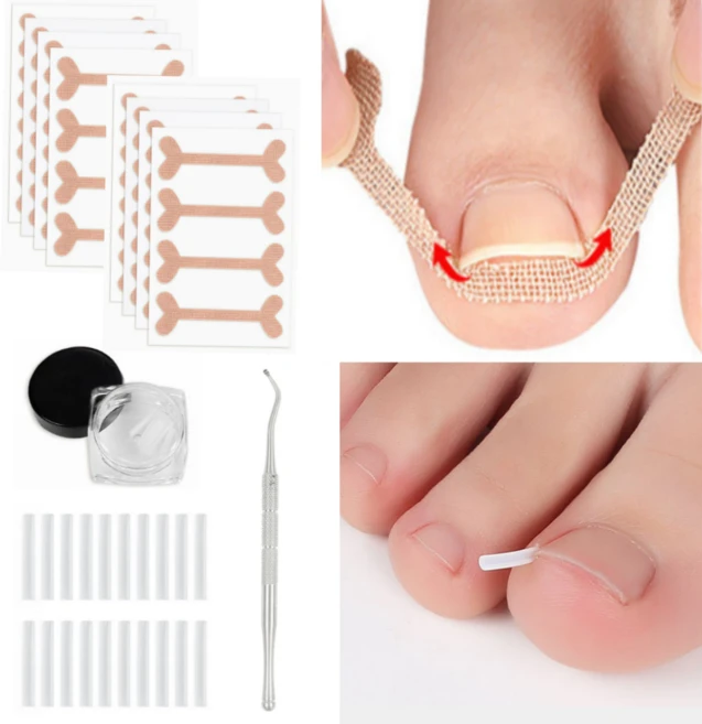 페어토 파고드는 발톱 관리용품 셀프 케어, 1개 - 쿠팡