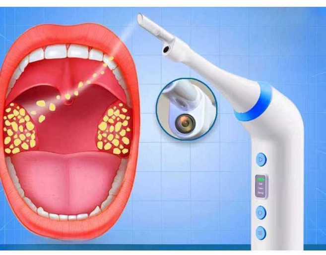 에인젤 편도결석제거기 구취 관리기 편도석 석션 셀프, 1개, 성능 세트 (내시경)
