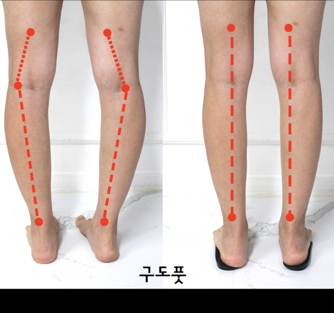 1+1 오다리 깔창 x다리 오다리용 팔자걸음 휜다리 걸음걸이 교정 2켤레 구도풋, 2세트
