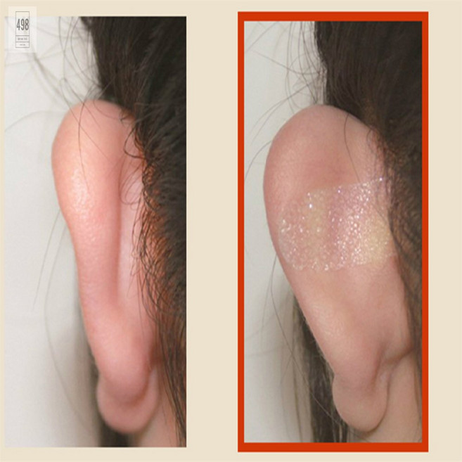 엘프 귀 스티커 귀세우는교정기, 홈없음, 1개