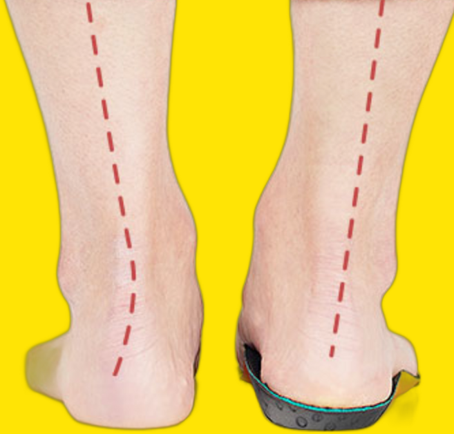 골반교정깔창 힙업깔창 서포트군화깔창 무지외반증깔창 후경골근보호대 부주상골증후군깔창