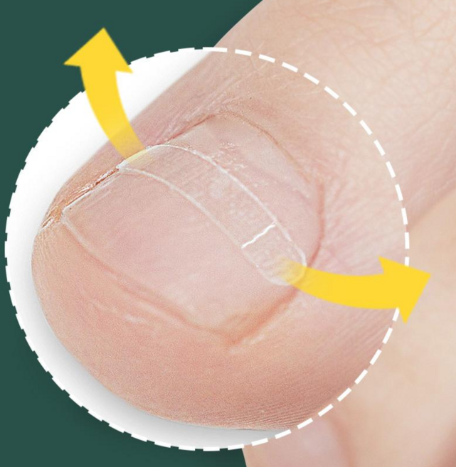 10매+10매 퍼펙토 내성발톱 교정기 스트립 교정팁 의료기기 자가치료 세트, 10개