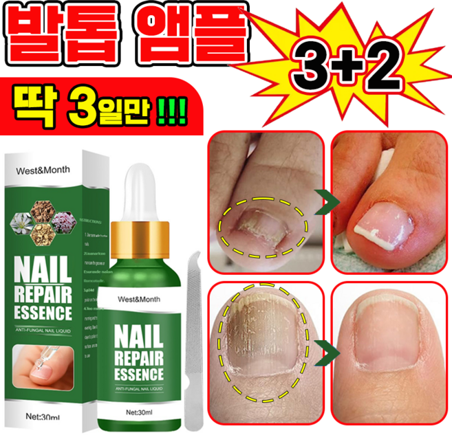 [국내배송] 발톱 거품나는앰플 솔루션 문제성발톱 앰플 발톱 곰팡이 한번에끝내는 손발톱 영양제 보장증정, 5개, 30ml