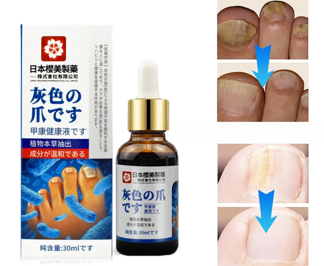 [국내당일출고] 발톱 앰플 발톱 곰팡이 문제성발톱 영양제, 1개, 29ml - 쿠팡