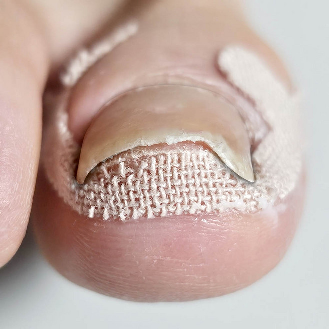 깔끔더하기 내성발톱 보호 밴드 케어 테이프, 40개