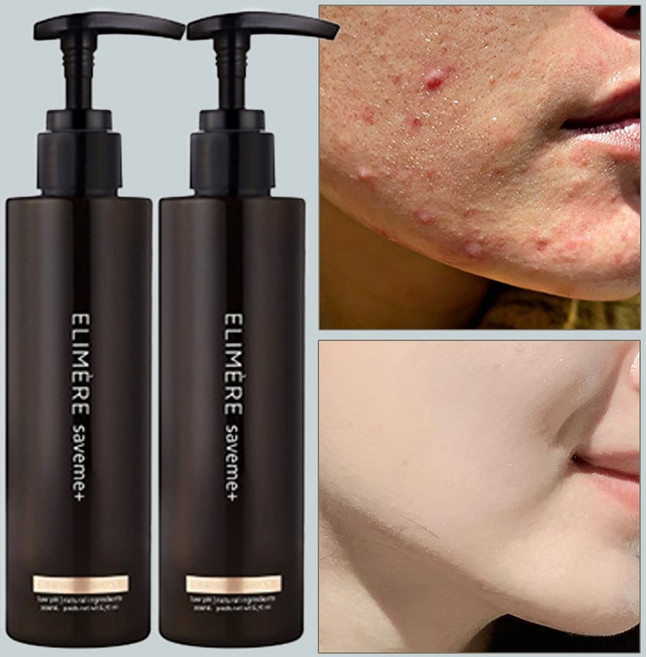 세이브미 약산성 블랙헤드 폼클렌징, 2개, 200ml